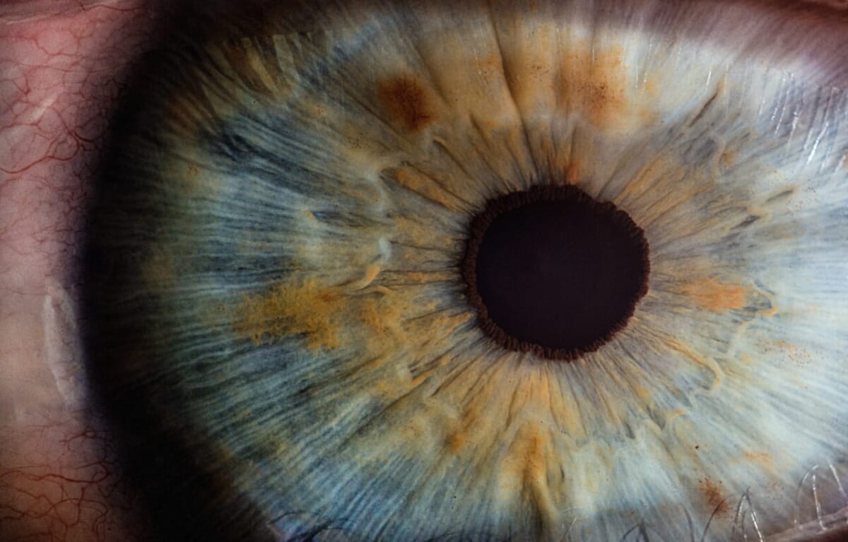 目を強打して打撲？眼球打撲傷・網膜振盪おかしいと思ったら検査。